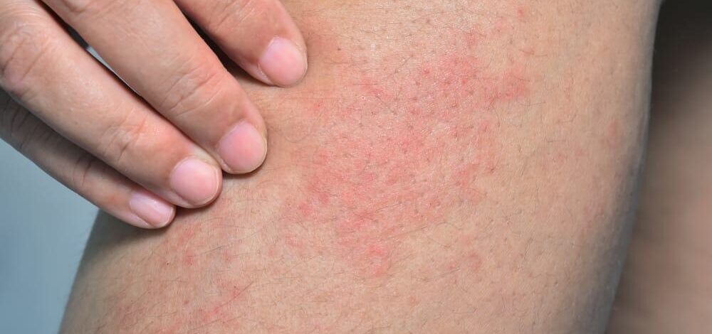 علائم و نشانه های آلرژی به کلر استخر چیست؟